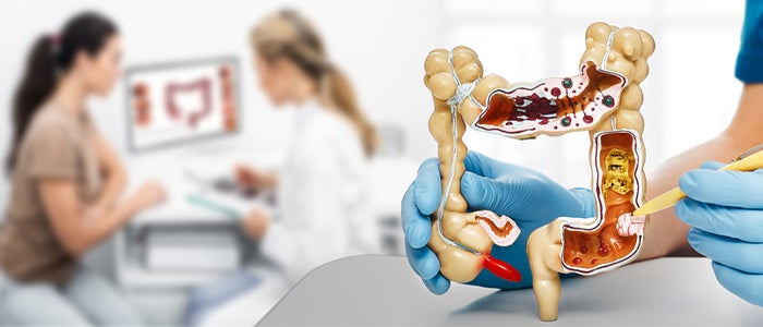Scientists develop promising new treatment for rectal cancer - The ...