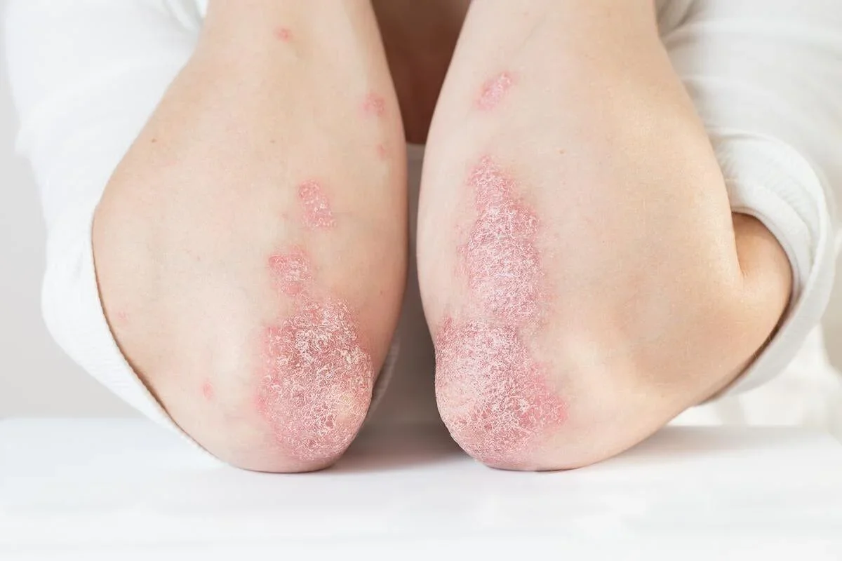 Eating ultraprocessed foods linked to psoriasis development