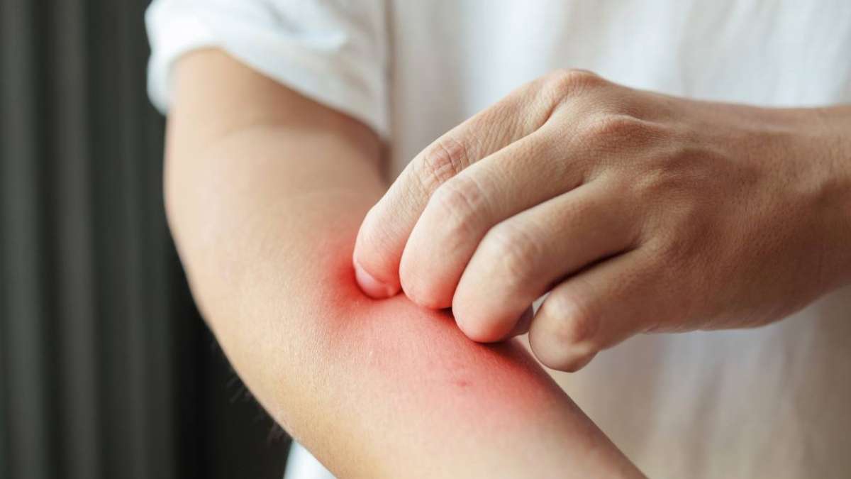 For individuals with psoriasis, this study underscores the potential impact of diet on symptom management.