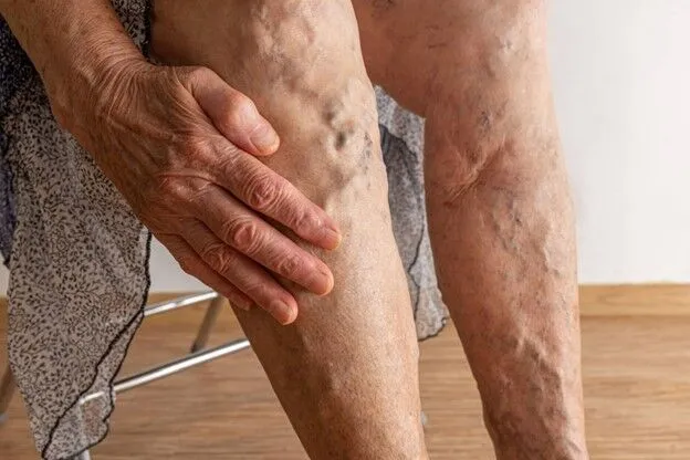 Deep vein thrombosis (DVT) occurs when a blood clot forms in deep leg veins.