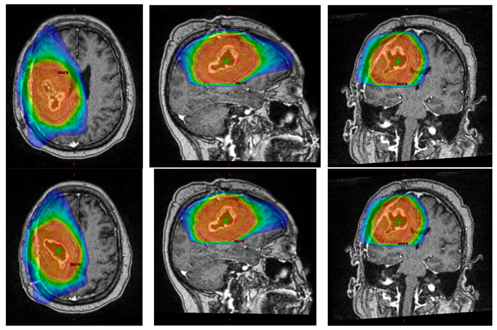 Proton beam therapy offers a breakthrough for older glioblastoma patients by selectively targeting tumors while sparing healthy brain tissue, reducing side effects and treatment burdens. This advancement improves both survival and quality of life, addressing key challenges for this vulnerable group.