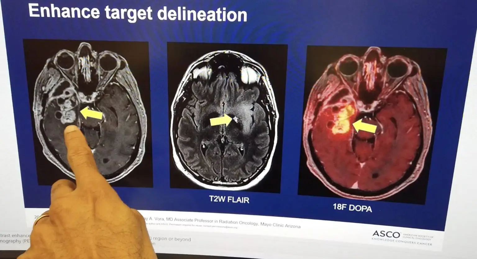 Glioblastoma is the most lethal type of primary brain cancer due to its aggressive nature and its treatment-resistant characteristics. It is the most common form of primary brain cancer. Each year an estimated 14,500 people in the U.S. are diagnosed with the disease.