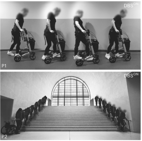 DBSLH mediates long-term improvements in walking in humans with SCI.