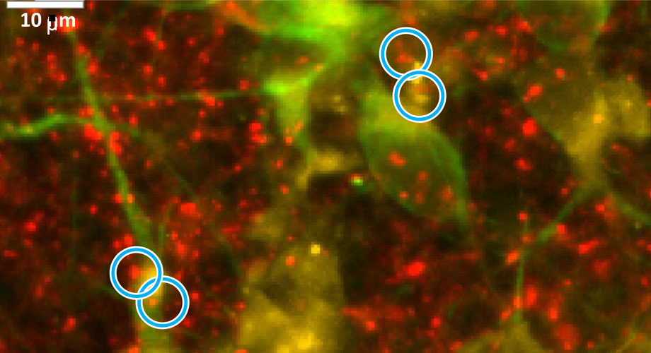 Alzheimer's nerve cells manifest a decrease in the connections between nerve cells, called synapses, shown here within the blue circles. Half the synapse is marked with a red fluorescent stain and the other half with a yellow stain.