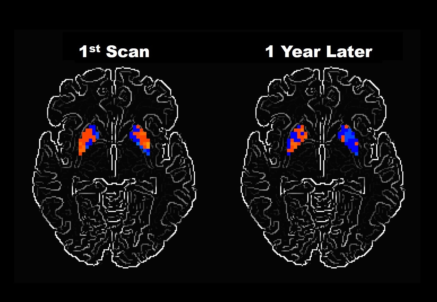 activity declines over time in different brain areas for people with Parkinson’s disease and 2 related syndromes.