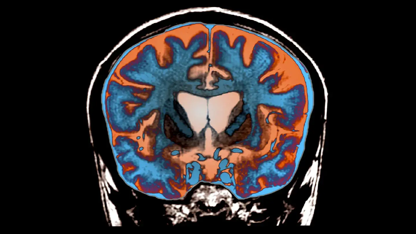 Scientists make main new discovery in battle towards Huntington’s illness Scientists make main new discovery in battle towards Huntington’s illness