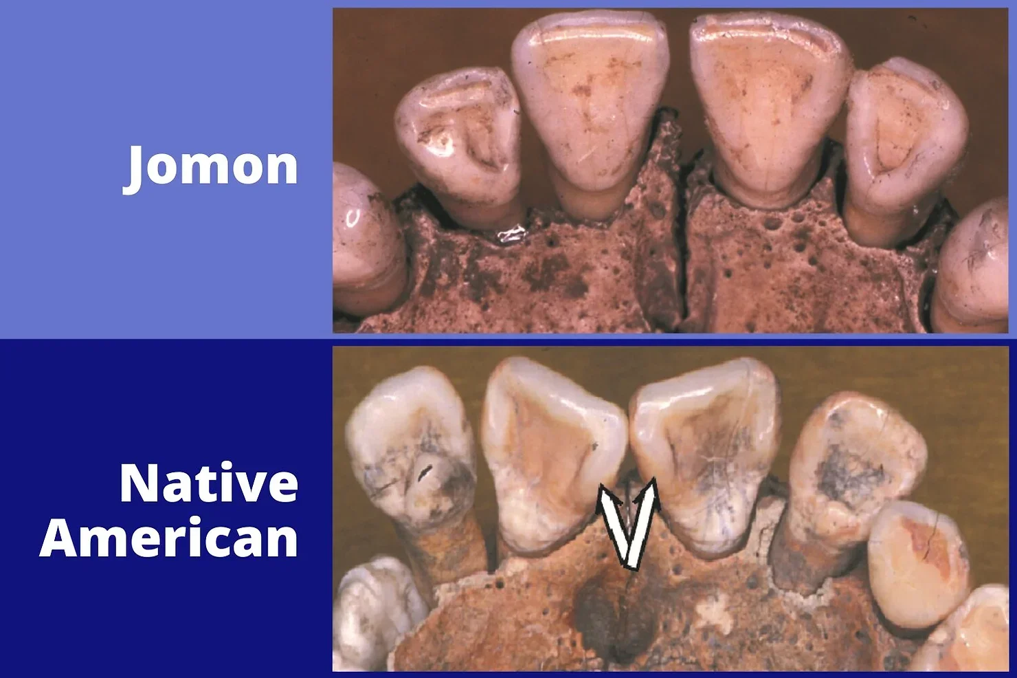 Jomon teeth vs Native American teeth.