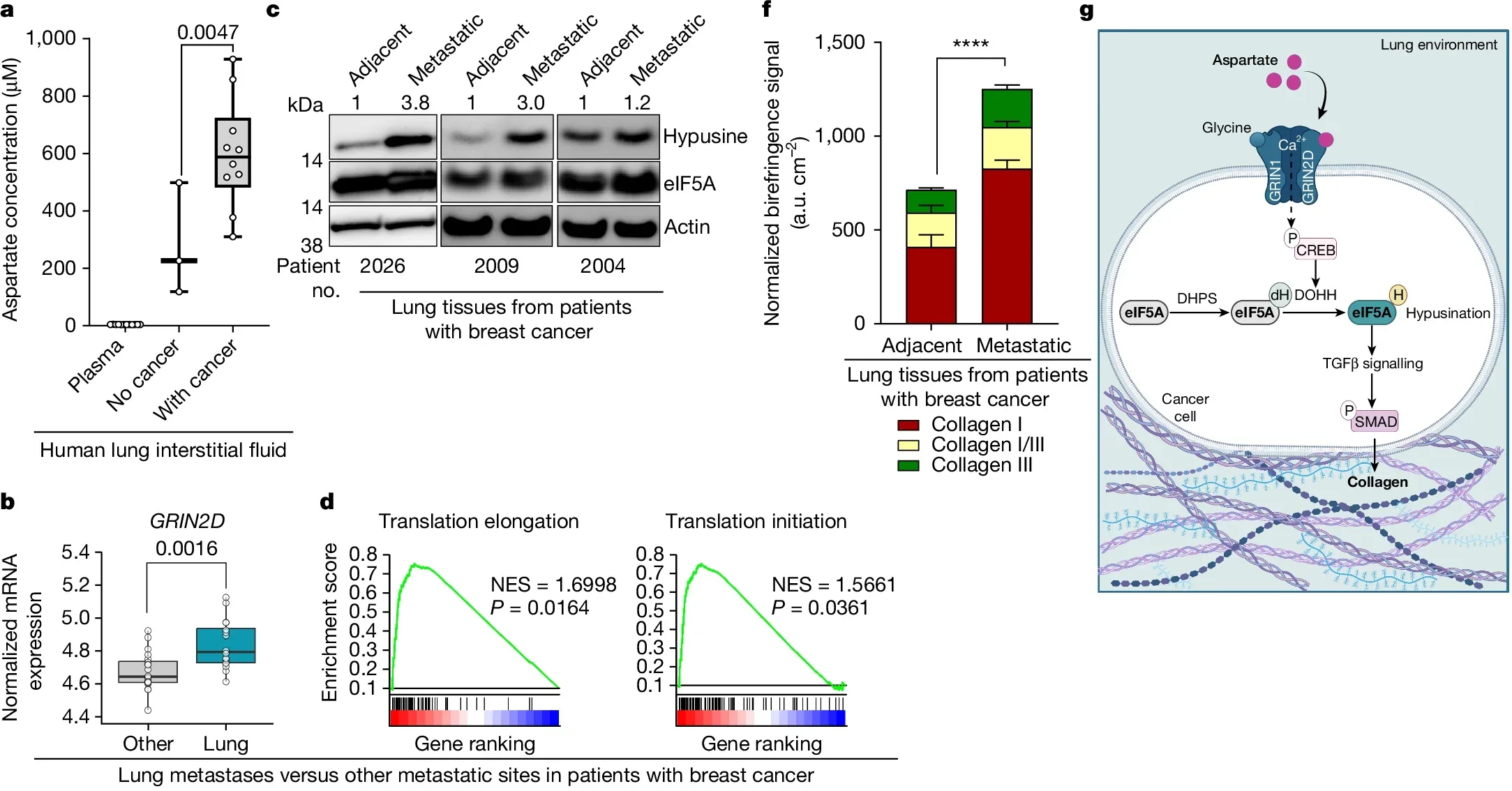 Evidence for aspartate signalling in lung metastases of patients with breast cancer.