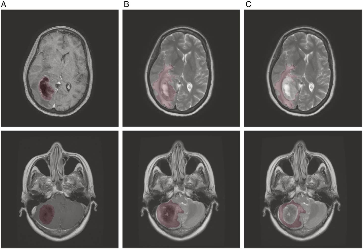 Examples of 2 MRI images, each in a row, with their overlaid manually segmented masks of (1) the metastatic tumor of interest, determined by the outer margins of the enhancing lesion on contrast-enhanced T1W images (shown in column A) and (2) edema (including primary tumor), determined by the outer margins of abnormal hyperintense signal on T2W images (visualized in column B).