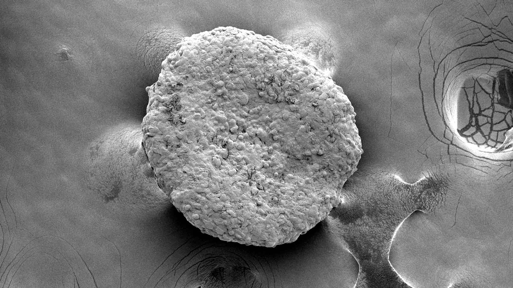 Clumps of energy-hungry beige fat cells, made from white fat cells taken via liposuction, ate up all excess nutrients and starved growing tumors in an animal model. The tumors shrank - even when the fat cells were implanted far from the tumor.
