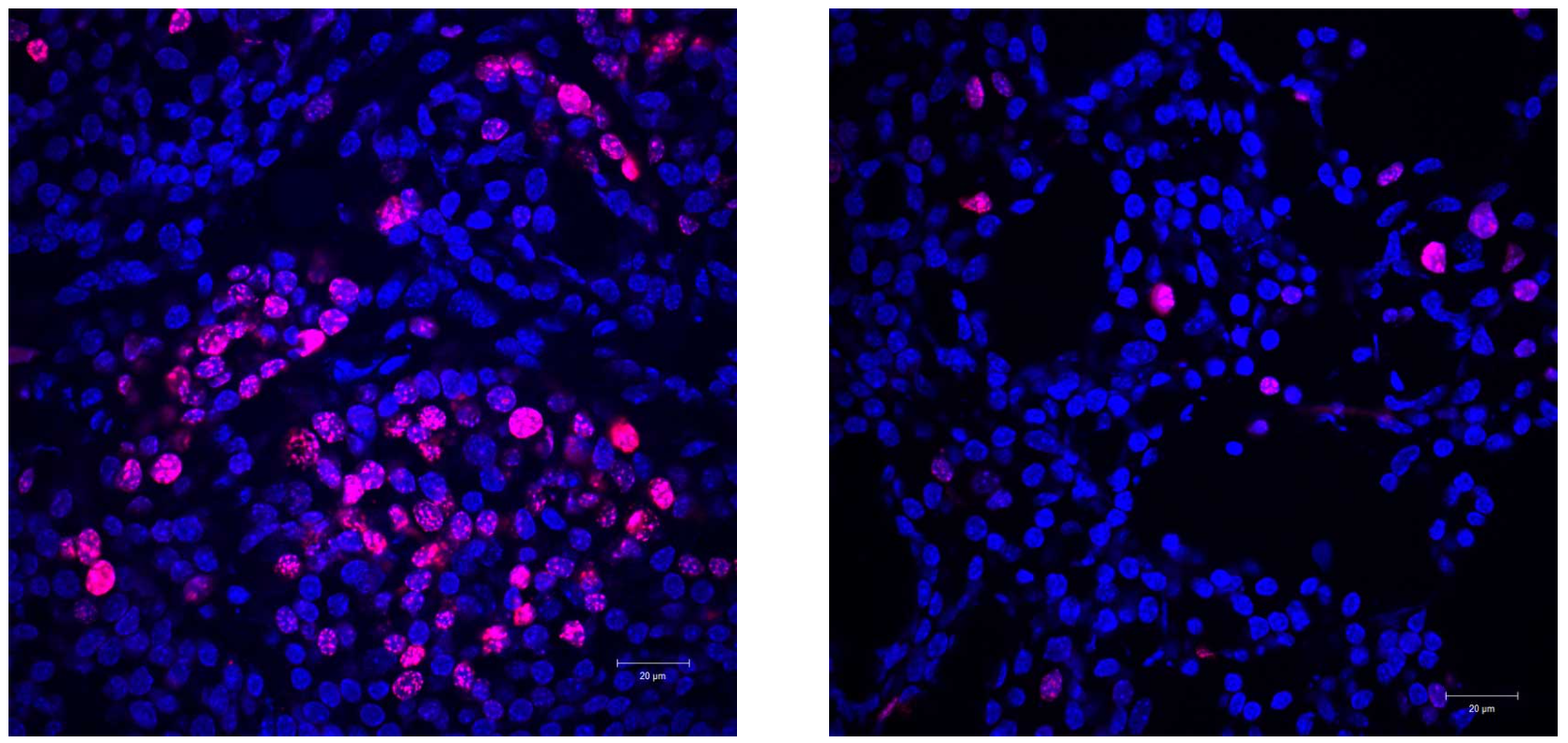 Panel 1: No fat cells: Actively-multiplying cancer cells (pink) are seen in a mouse predisposed to develop breast cancer. Panel 2:  Fat cells are added: When fat cells were implanted in the breast, far fewer cancer cells were able to multiply.