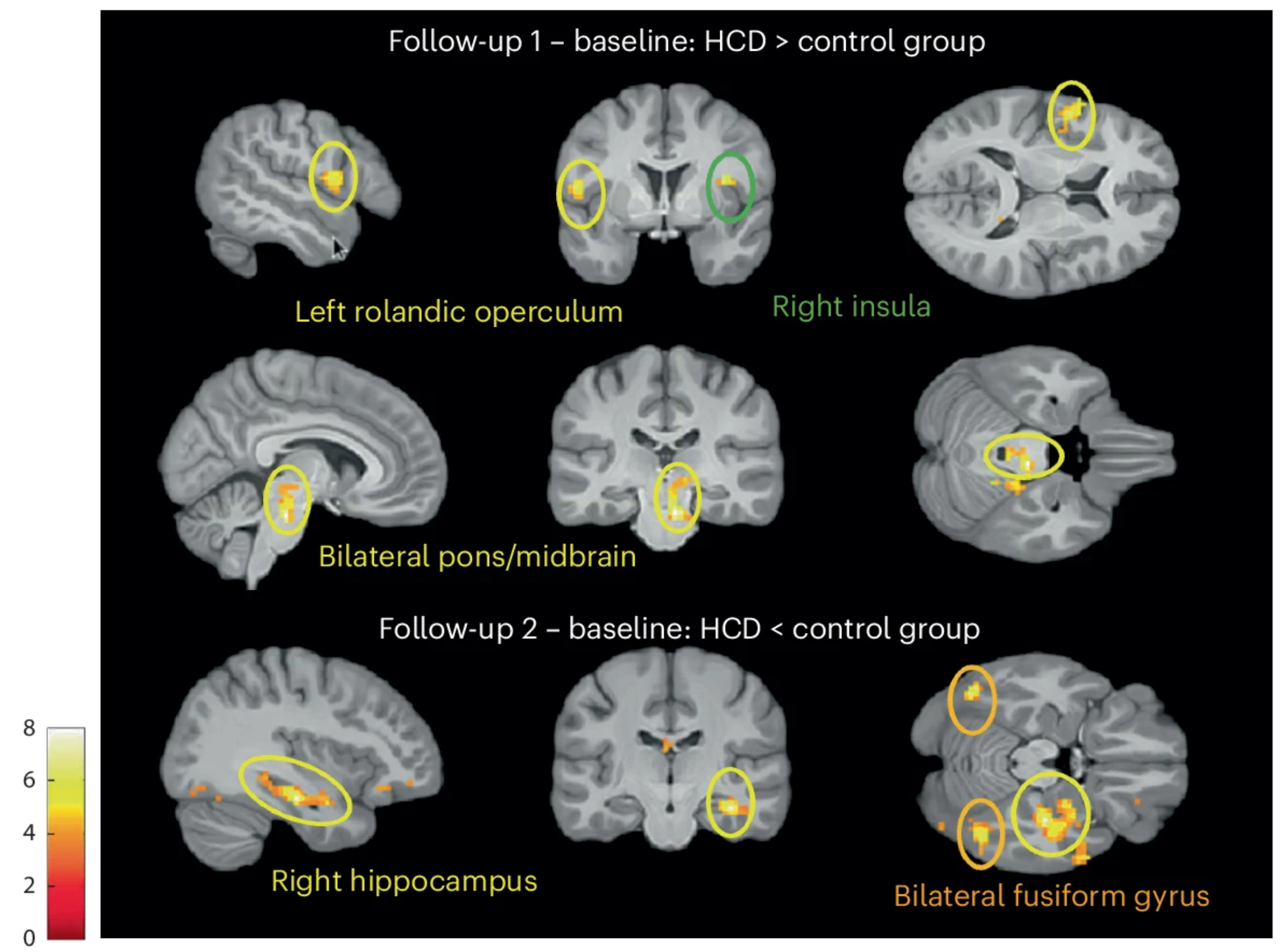 Changes in brain insulin activity at follow-up 1 (directly after the 5-day HCD or regular diet) and follow-up 2 (1 week after resuming the regular diet) in HCD compared with the control group. 