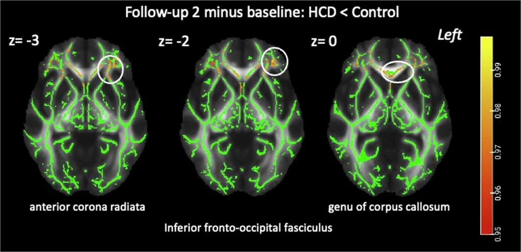 Change in white matter organization at follow-up 2 in the high-caloric diet compared to the control group.