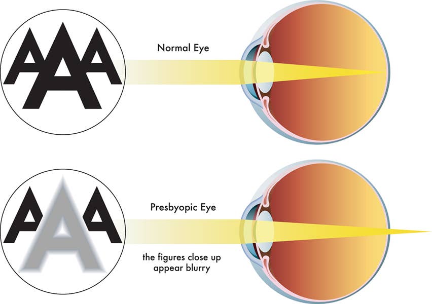 Presbyopia typically develops in adults over 40 as the eye’s lens loses its flexibility, making it harder to focus on nearby objects.