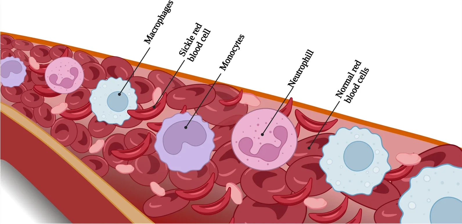 Flow of normal blood and sickle shape of blood along with its all components in blood vessels.