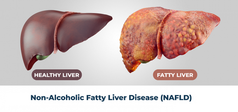 Fatty liver disease begins when excess fat builds up in your liver, typically due to obesity or overweight.