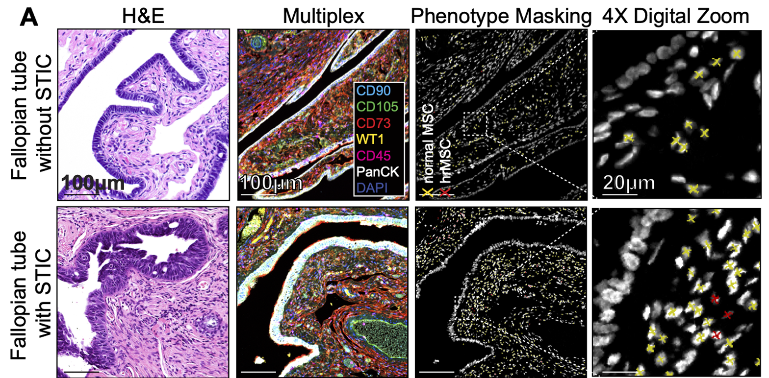 Representative H&E-stained tissue sections of normal fallopian tubes and fallopian tubes harboring STIC lesions.