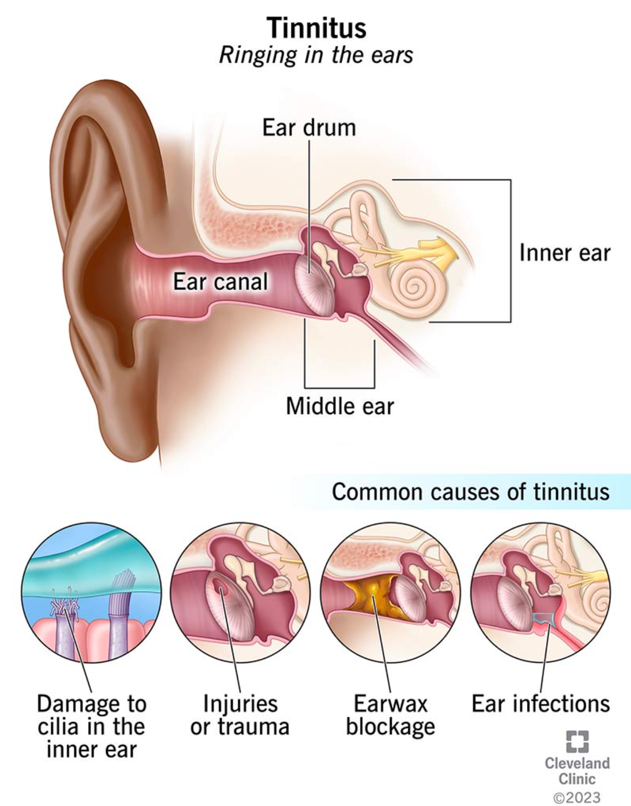 What is tinnitus and what are its common causes?