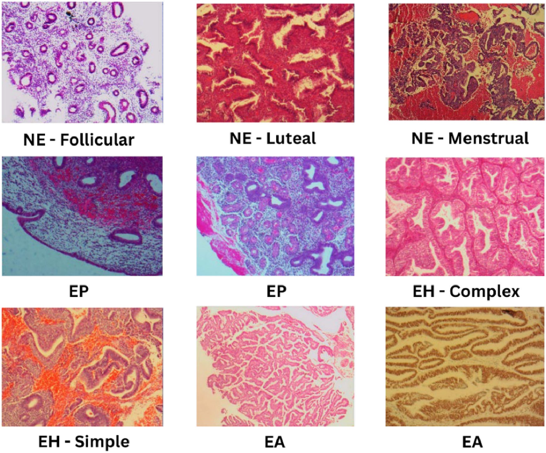 Sample images of four classes with their subtypes. Endometrial adenocarcinoma, endometrial hyperplasia, endometrial polyps, and normal endometrium. Each category contains a distinct number of images and subtypes. 