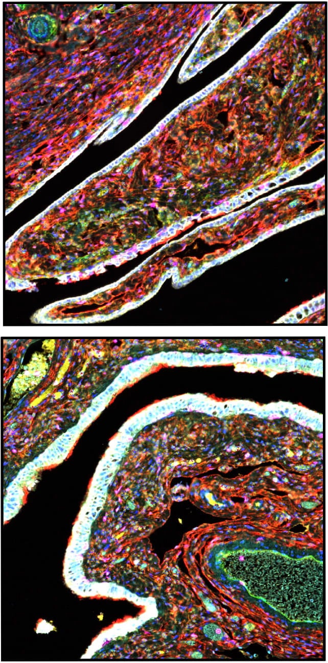 High-risk MSCs (yellow) are more abundant in fallopian tubes from patients with STIC lesions (bottom) compared to those without these lesions (top).