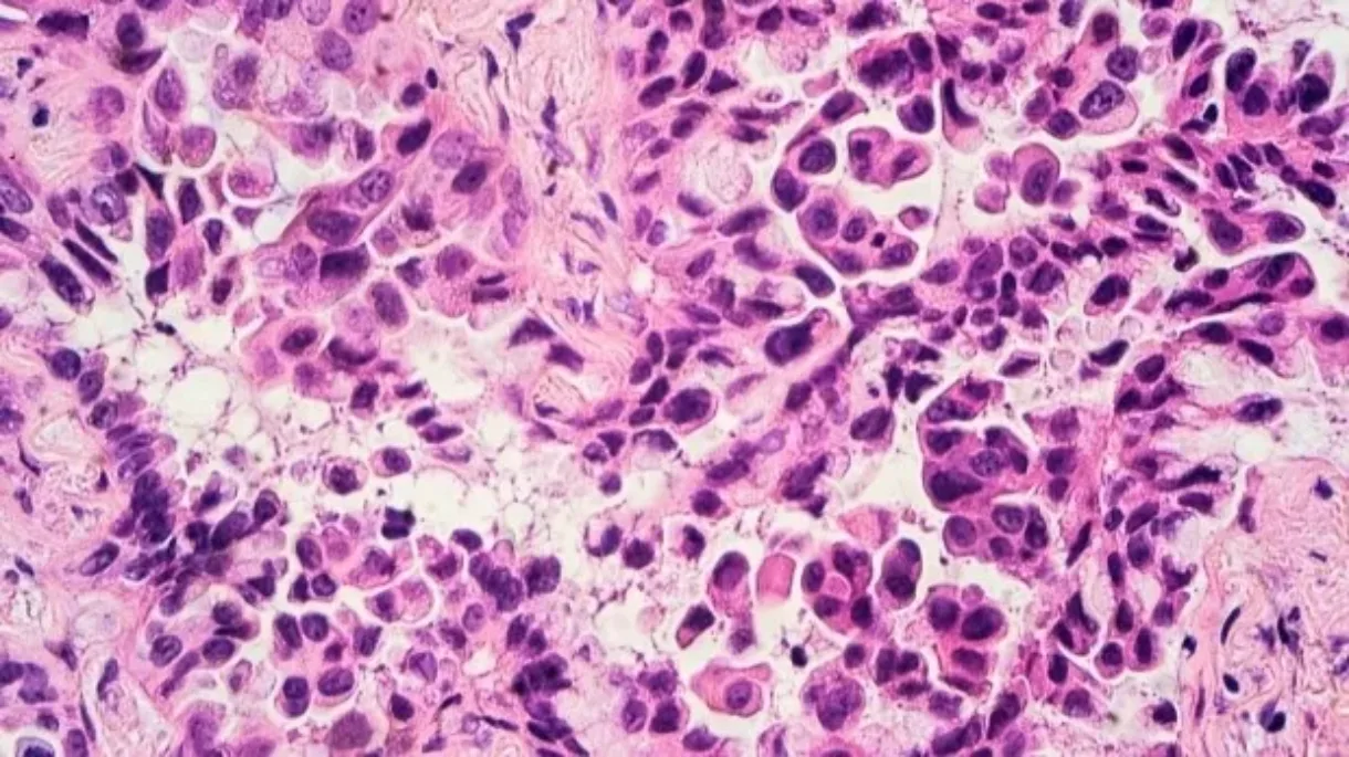 Lung adenocarcinoma cells, a type of non small cell lung cancer.