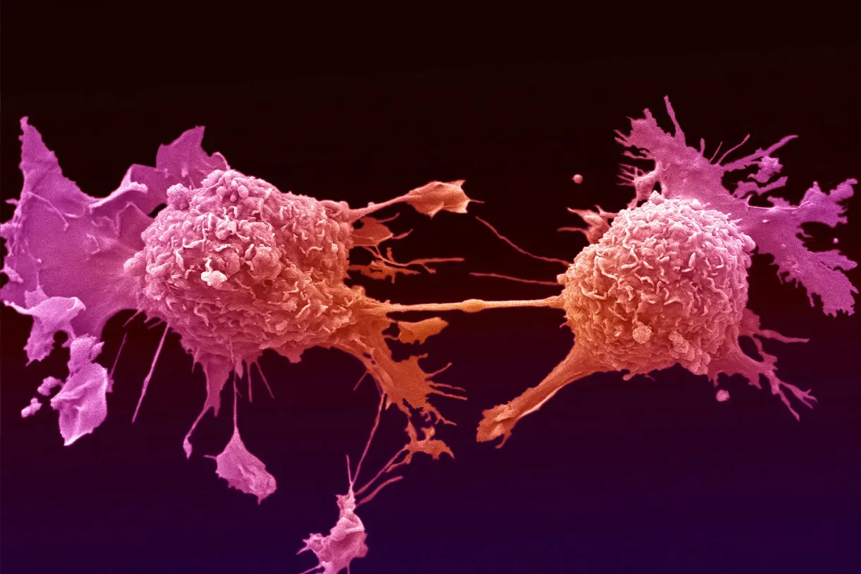 This microscope image shows a cancer cell dividing. 