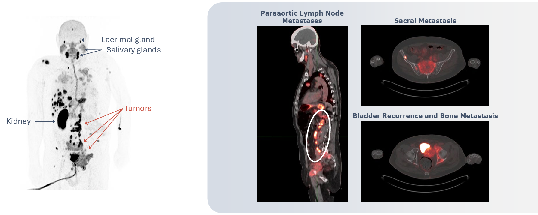 Robust tumor uptake with kidney as potentially dose-limiting normal tissue. 