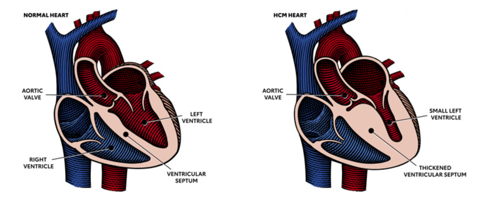 Hypertrophic cardiomyopathy is most often caused by abnormal genes in the heart muscle. These genes cause the walls of the heart chamber (left ventricle) to become thicker than normal.