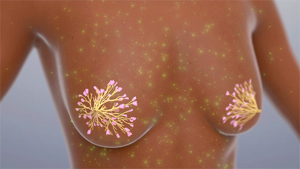 The vaccine targets a lactation protein called α-lactalbumin, which is no longer found after lactation in normal, aging tissues but is present in most triple-negative breast cancers. If breast cancer develops, the vaccine is designed to prompt the immune system to attack the tumor and keep it from growing.