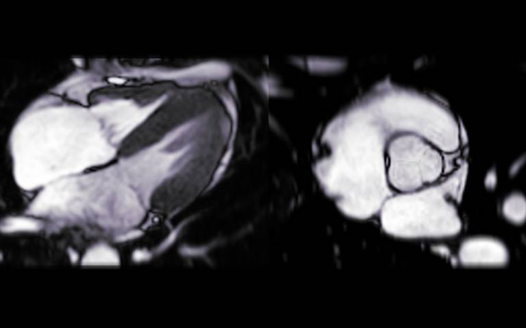 MRI heart scan.