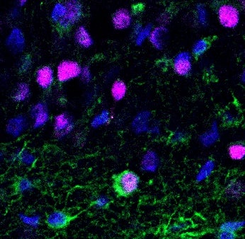 Newborn neuron (green and purple cell) in brain tissue from patients with epilepsy.