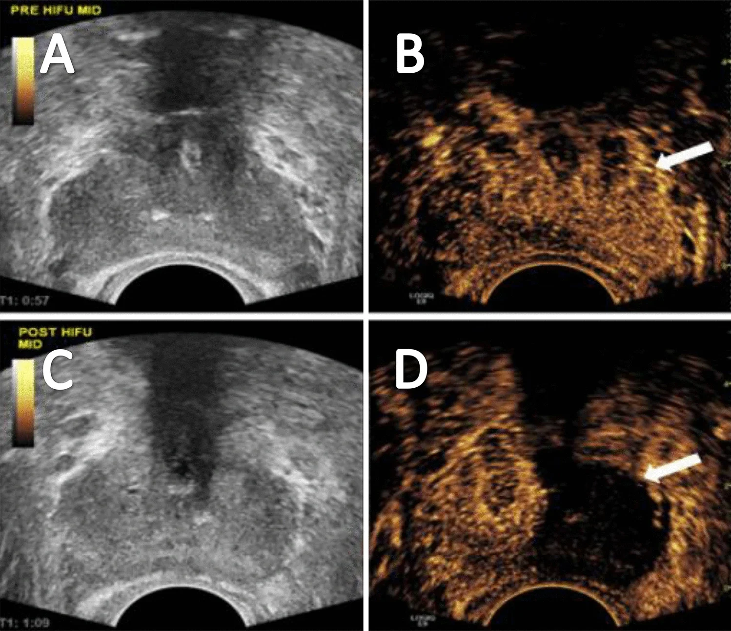 Contrast-enhanced transrectal ultrasound.