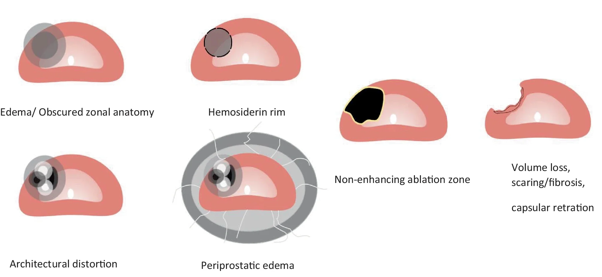 The changes seen in imaging after focal ablation of the prostate based on the duration. On left, it shows early changes happening in the first days-weeks after the ablation, while the pictures come toward the right show late changes happening more than 6 months after the ablation in the gland.