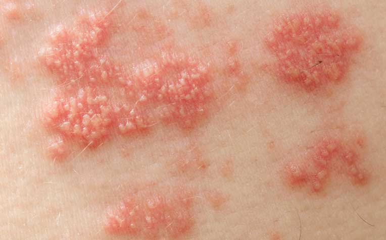 Shingles occurs when the virus responsible for chickenpox, varicella-zoster, reactivates later in life. 