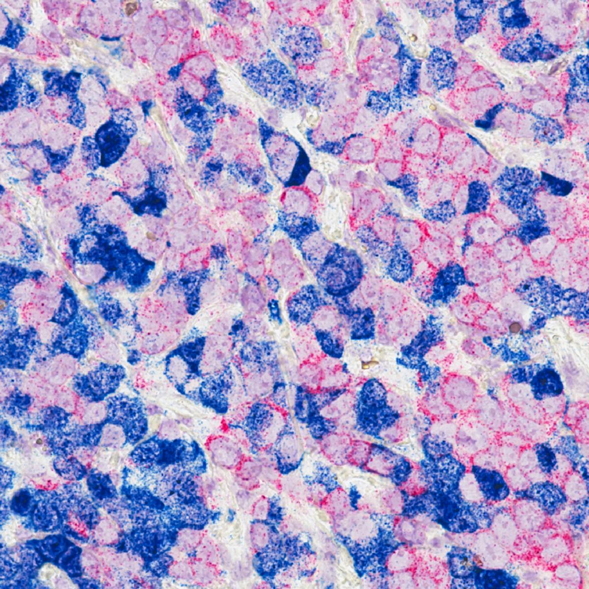 Light-sensitive chemicals called cyanine-carborane salts that are used in photodynamic therapy, or PDT, to destroy metastatic breast cancer tumors in mice with minimal side effects.