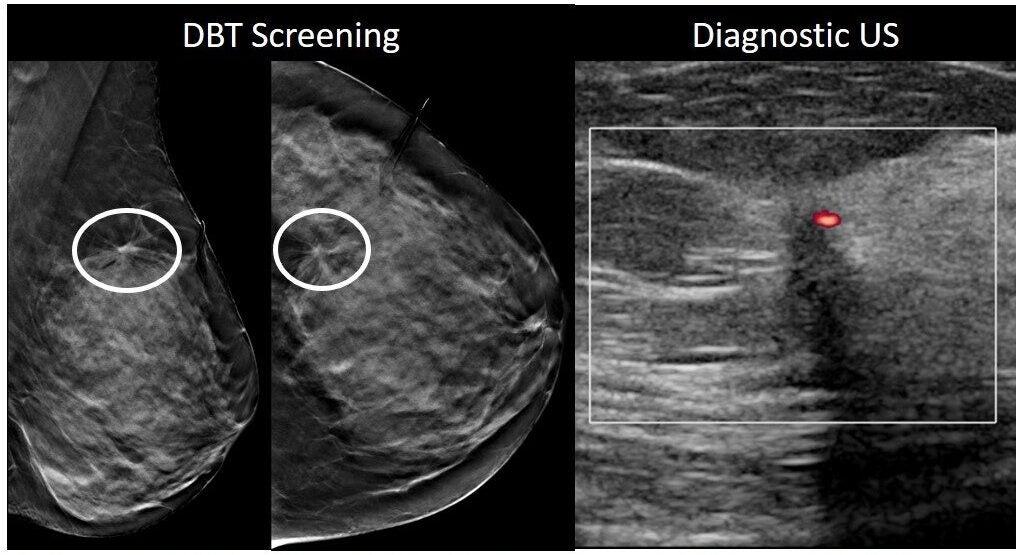 Example of missed reading error (missed / misinterpreted by radiologist)