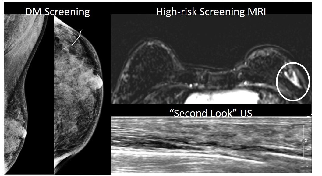 Example of Occult (mammographically occult; detected by ultrasound or MRI). 