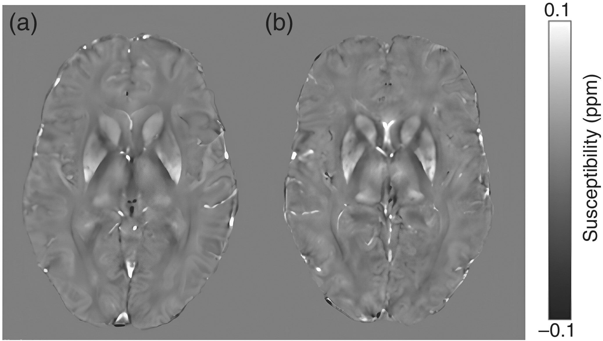 Quantitative susceptibility maps for (a) a healthy control (42-year-old female) and (b) a subject with ADHD (26-year-old female). Increased susceptibility values are visible in iron-rich deep gray matter structures, such as the caudate nucleus, precuneus and caudal anterior cingulate on ADHD population.