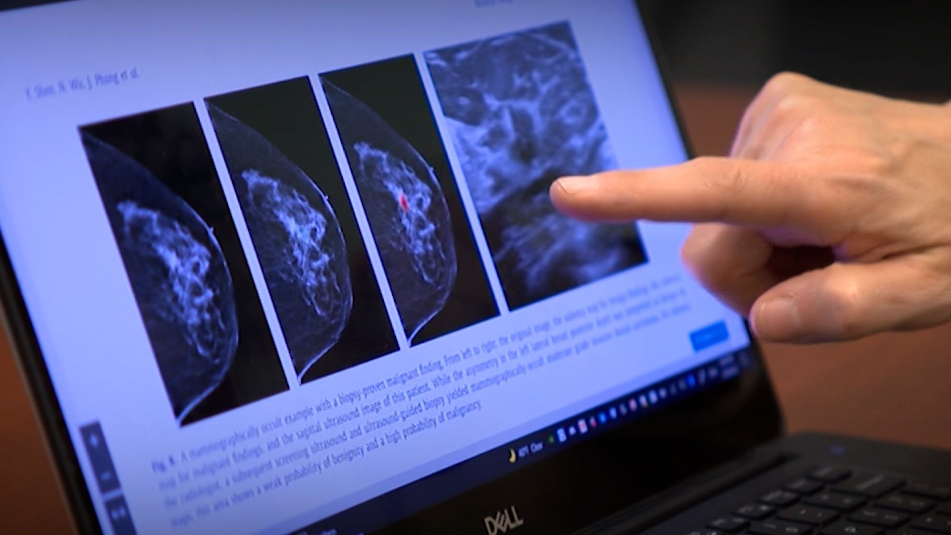 With the help of AI, researchers believe it's possible to reduce the number of missed diagnoses and improve outcomes for many patients.