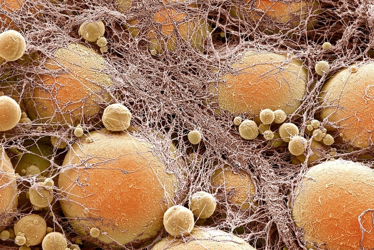 Breakthrough cell therapy stops cancer by stealing its nutrients