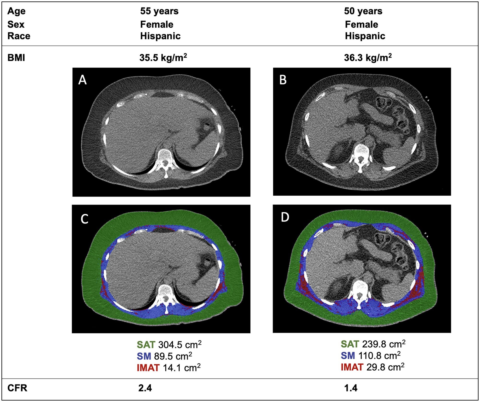 Characterization of thoracic body composition at the 12th thoracic vertebra (T12) level in representative patients (A/C, B/D) of similar age, sex, race, and body mass index with normal renal function, left ventricular ejection fraction, and myocardial perfusion.