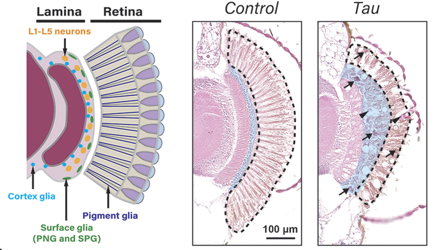 Expression of human Tau in fly retina causes photoreceptor degeneration, swelling of the laminal cortex and the formation of inclusions.