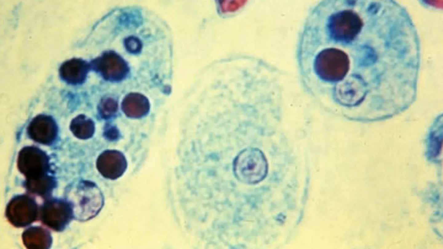 Entamoeba histolytica in the trophozoite stage.