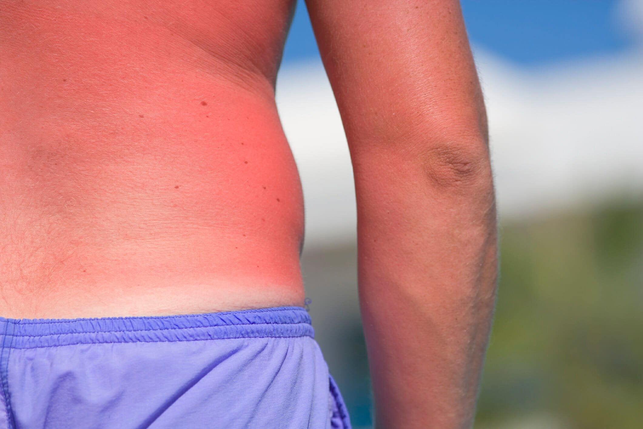 Painful sunburn marks early UV damage, now known to be triggered by RNA—not DNA—as new research shows.