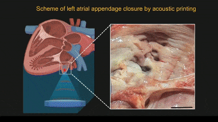 The printing process of DAVP can close the left atrial appendage within minutes. The thermal image shows the temperature rise during the printing. (CREDIT: Junjie Yao, Duke University; Shrike Yu Zhang, Harvard Medical School)