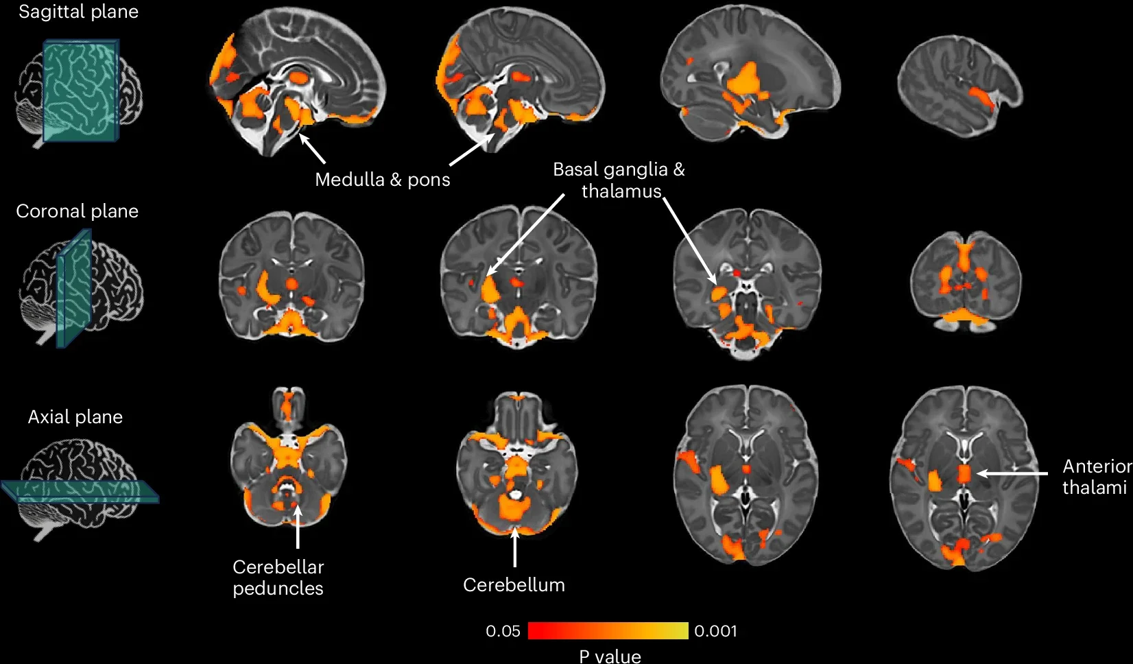 Brain regions with statistically significant positive correlation between tissue volume and age at onset of walking polygenic score in the Developing Human Connectome Project cohort.