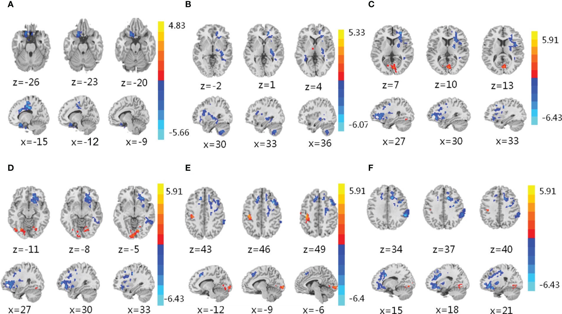 Functional magnetic resonance imaging (fMRI). (A–F) fMRI was conducted to assess brain activity in the left inferior frontal orbital gyrus (A), putamen (B), right putamen (C), right inferior frontal orbital gyrus (D), left dorsolateral prefrontal cortex (E), and anterior cingulate cortex (F) of obese participants in response to IER. 