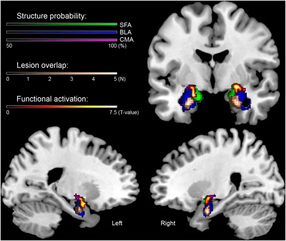 Structural and functional magnetic resonance imaging (MRI) assessment of the bilateral amygdala in a group of subjects with Urbach–Wiethe disease
