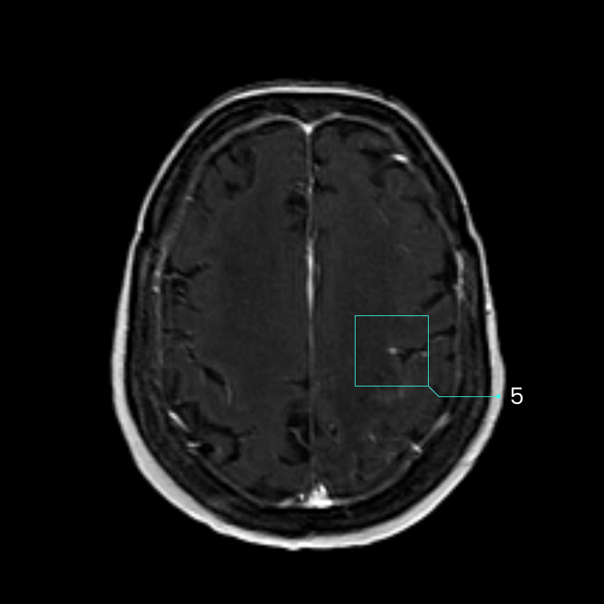 What happens if lesions are smaller than what can be found with the naked eye?