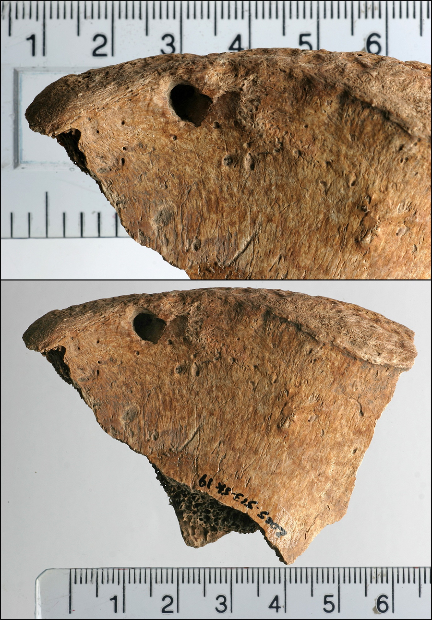 Lesions on the left iliac spine